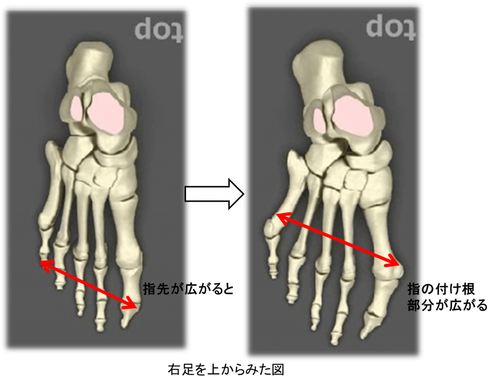 足の小指が曲がってきて痛い 内反小趾 ないはんしょうし の症状と原因 Ashinavi