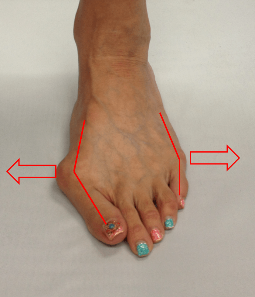 足の小指が曲がってきて痛い 内反小趾 ないはんしょうし の症状と原因 Ashinavi