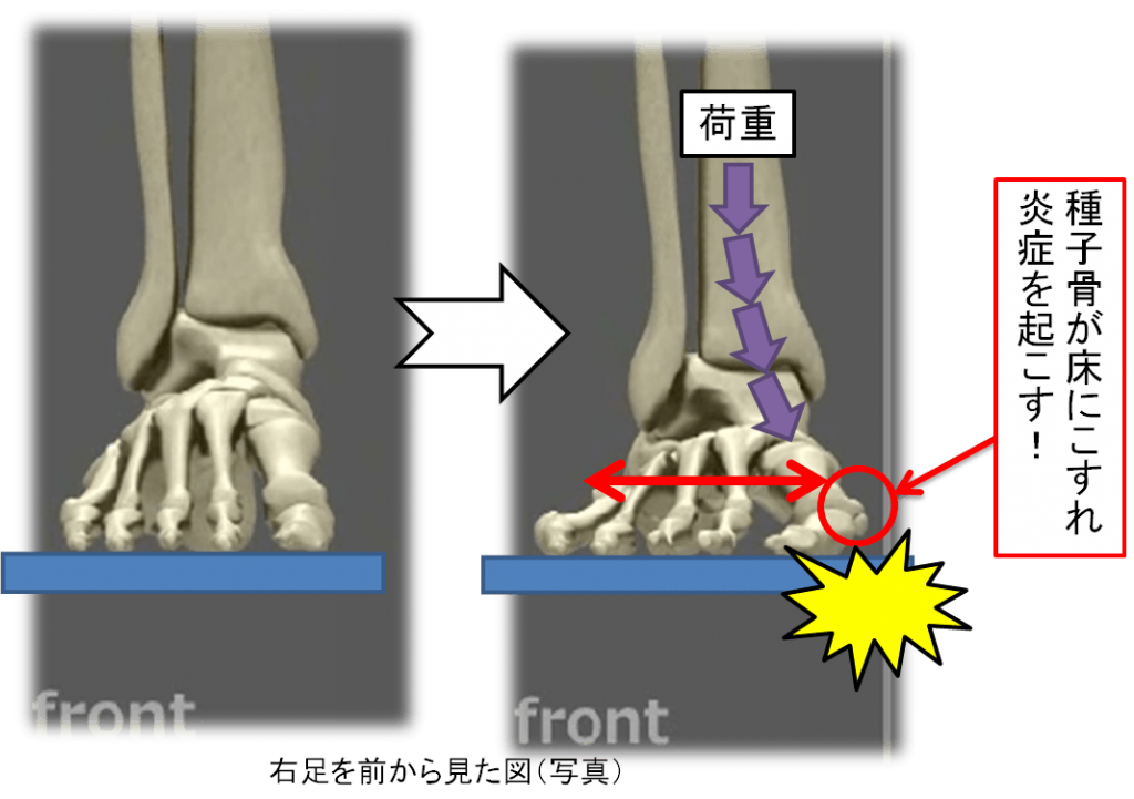 足指の付け根が痛む さまざまな症状と原因 Ashinavi