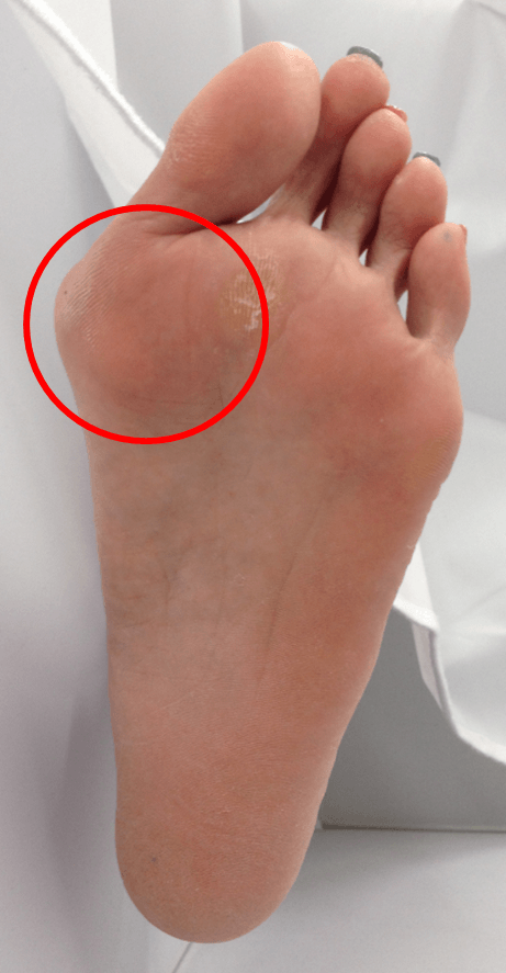痛み 付け根 足 親指 の 足指の付け根が痛む…さまざまな症状と原因