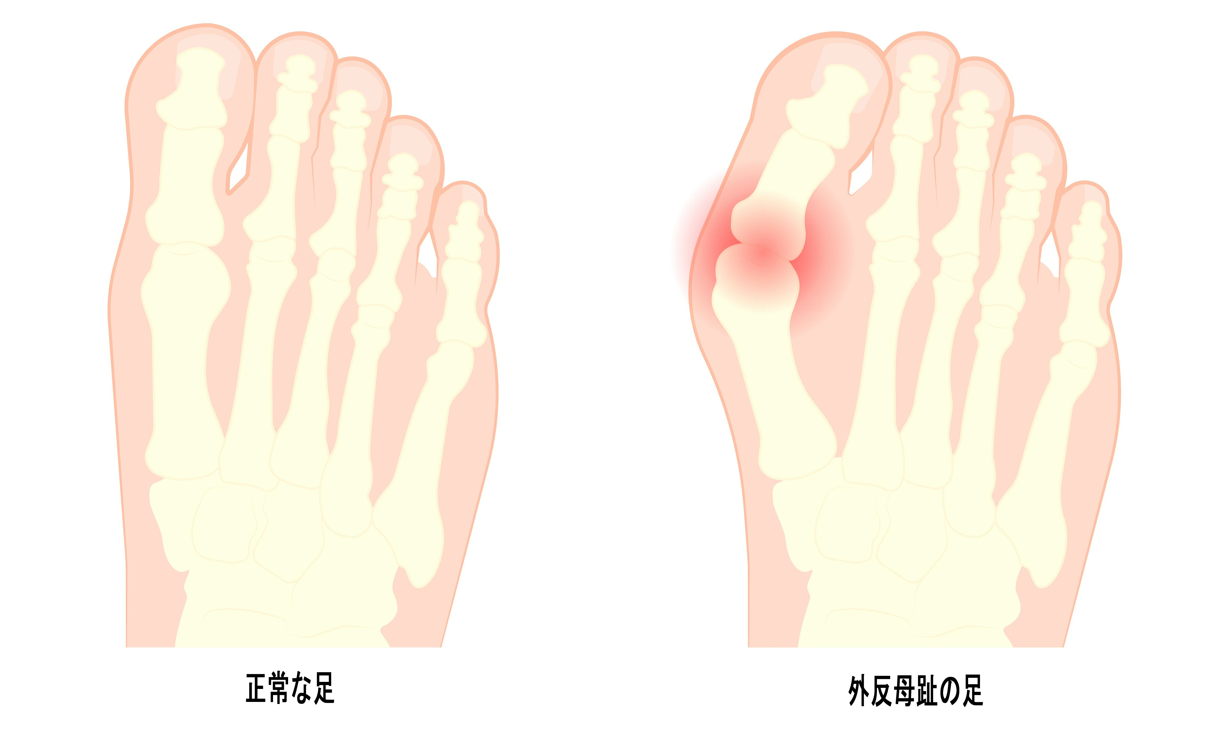 足の指のつけ根の痛み 症状と原因 共通する要因としてのオーバープロネーション Ashinavi