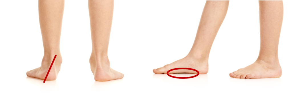 偏平足はオーバープロネーションの足の代表的な事例のひとつ