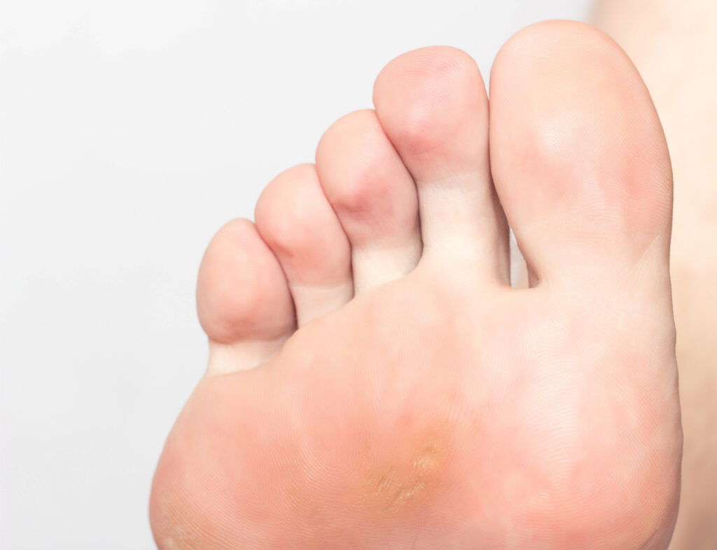 タコ・ウオノメ紹介写真 足の悩みは何ですか？