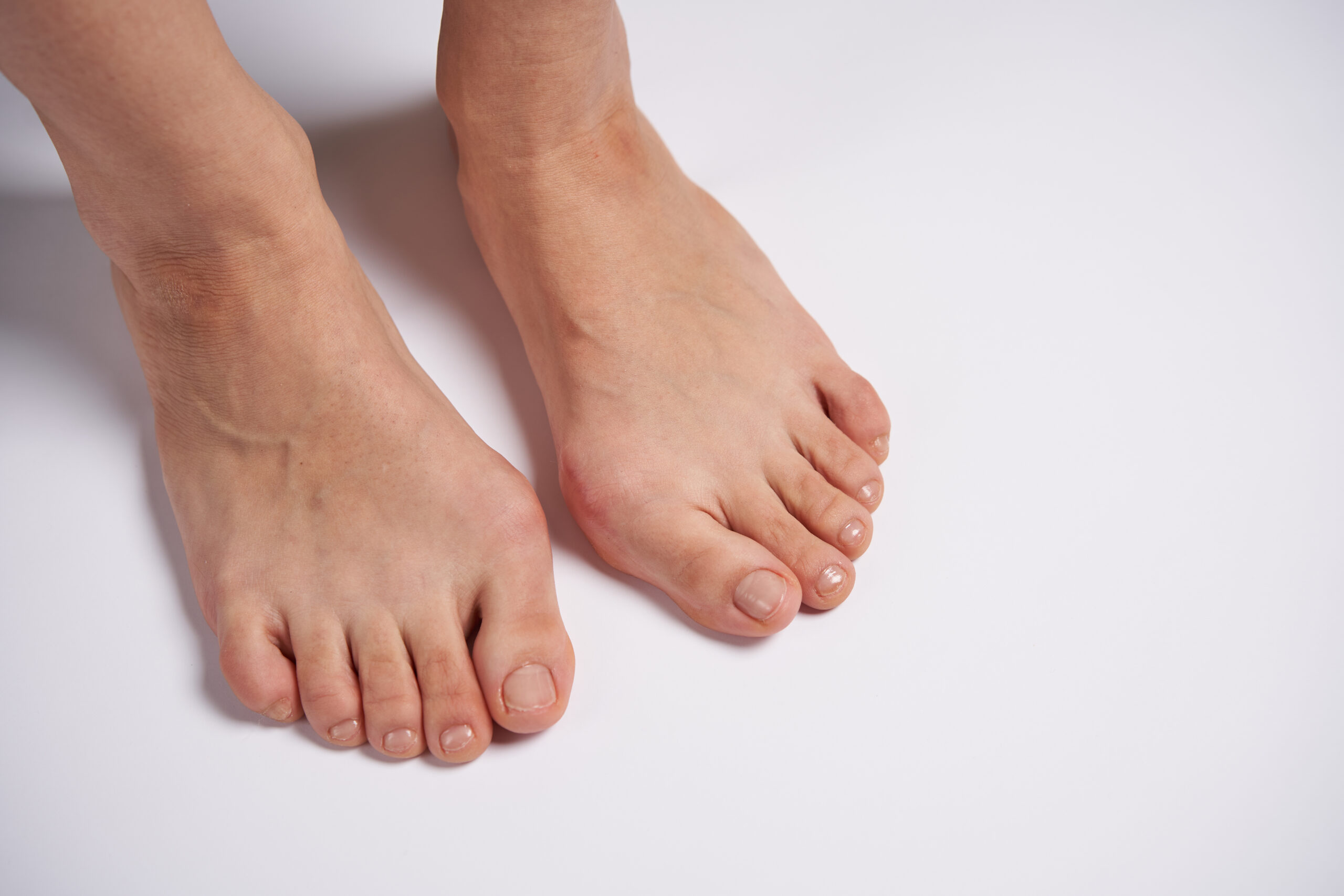 外反母趾の写真
足の悩みは何ですか？
NWPL社のファンクショナルオーソティックス®およびファンクショナルインソール
理学療法士、鍼灸師が担当する無料悩み相談"足のお悩み相談会" 　外反母趾写真