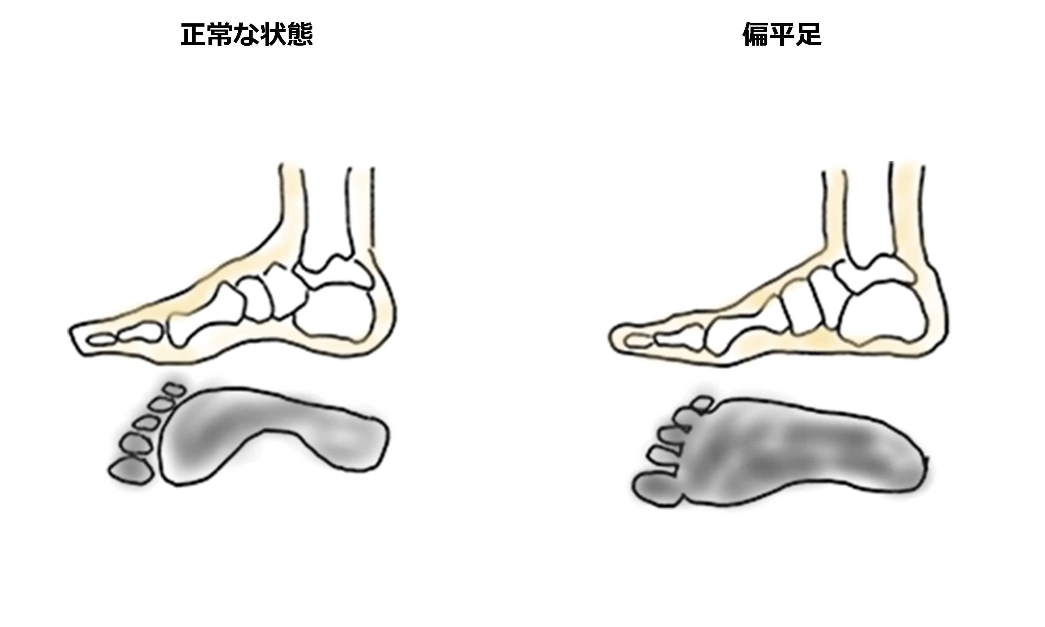 偏平足はアキレス腱炎の遠因ともなりえる過剰回内（オーバープロネーション）の足が示す典型的な足の形態