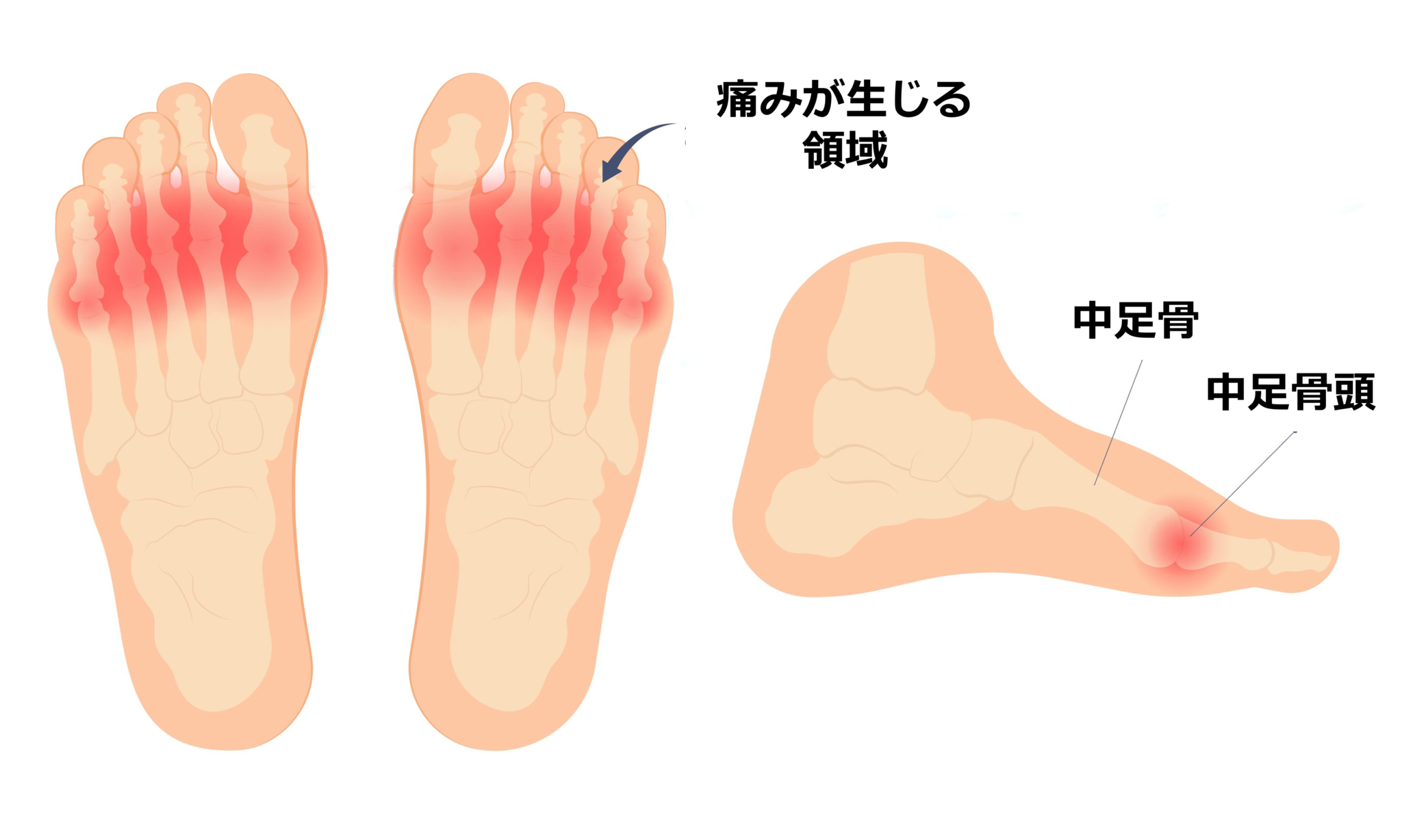 足の指のつけ根の痛み：症状と原因 共通する要因としてのオーバープロネーション - ashinavi