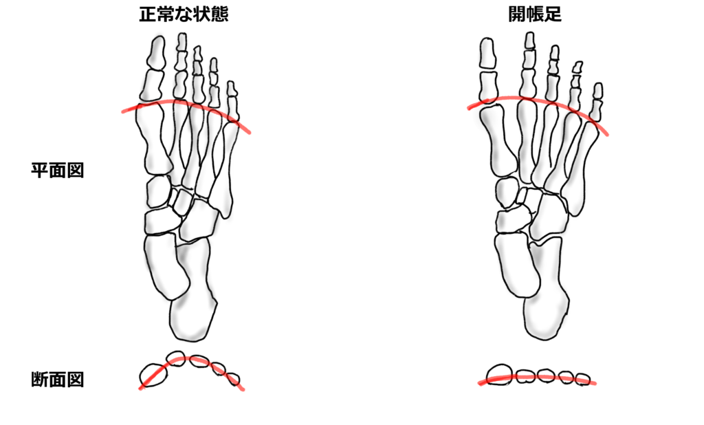 開帳足の足
足の指が広がった状態となる開帳足もオバープロネーションの足が示す典型的な足の状態