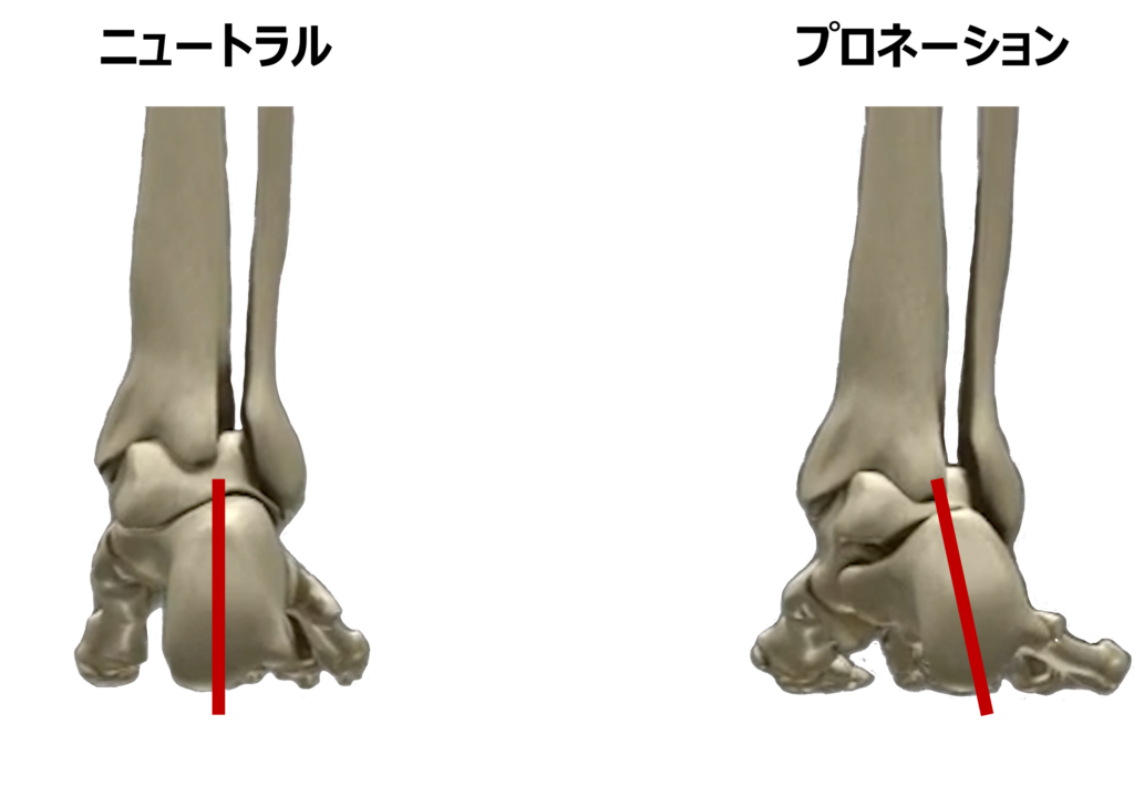 ニュートラルな足とプロネーションの足
かかとの骨（踵骨）がどこまで傾くかという点については議論があるが、踵骨やその上の距骨のかみ合わせが緩いと、かかと周りの骨の挙動が大きくなり、足がオーバープロネーション（過剰回内）の状態となりやすい。