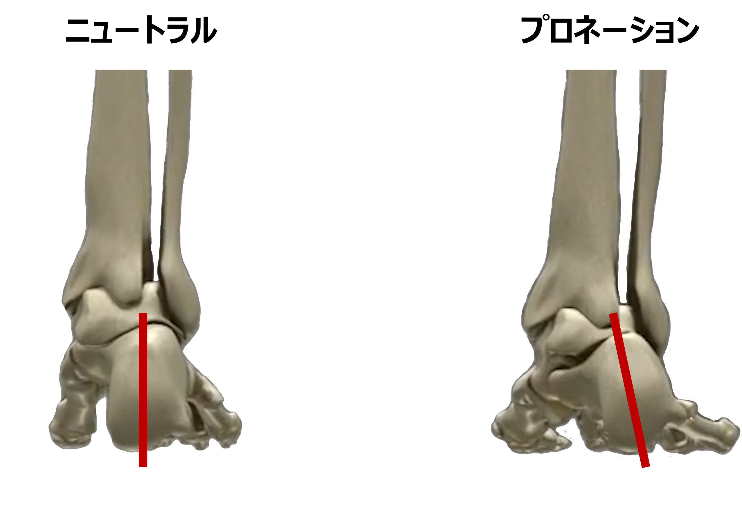 ニュートラルな足とプロネーションの足の比較
かかとの骨（踵骨）がどこまで傾くかという点については議論があるが、踵骨やその上の距骨のかみ合わせが緩いと、かかと周りの骨の挙動が大きくなり、足がオーバープロネーション（過剰回内）の状態となりやすい。