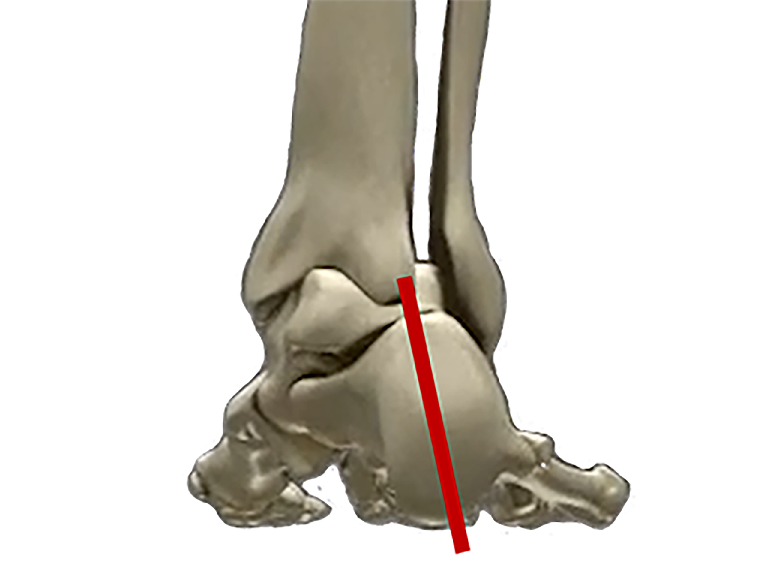 右足のかかと周りの骨の図
足の悩み何ですか？
過剰回内
オーバープロネーション
NWPL社のファンクショナルオーソティックス®およびファンクショナルインソール