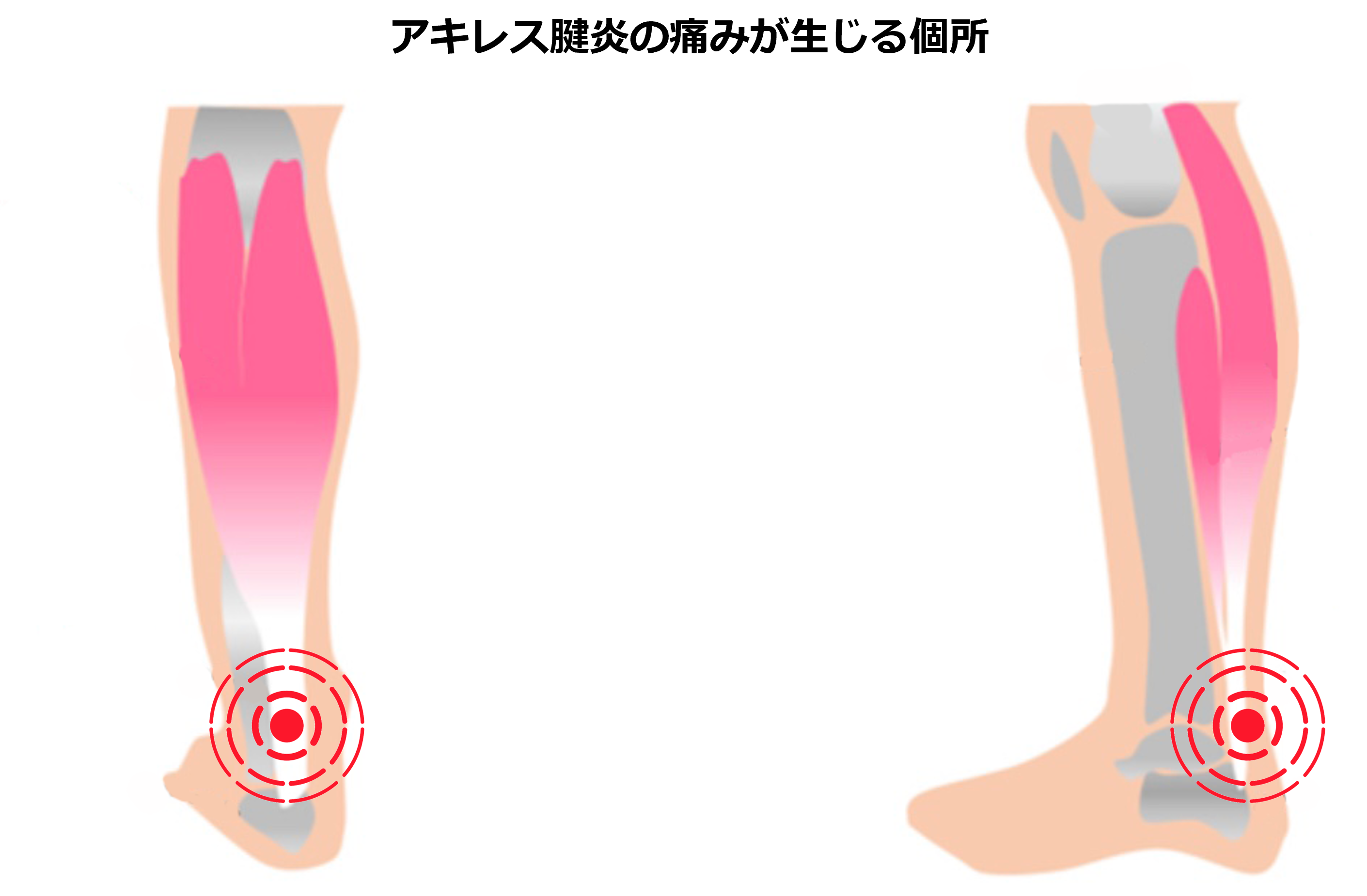 アキレス腱炎の生じる個所は、かかとの後部、アキレス腱のつけね部分です。