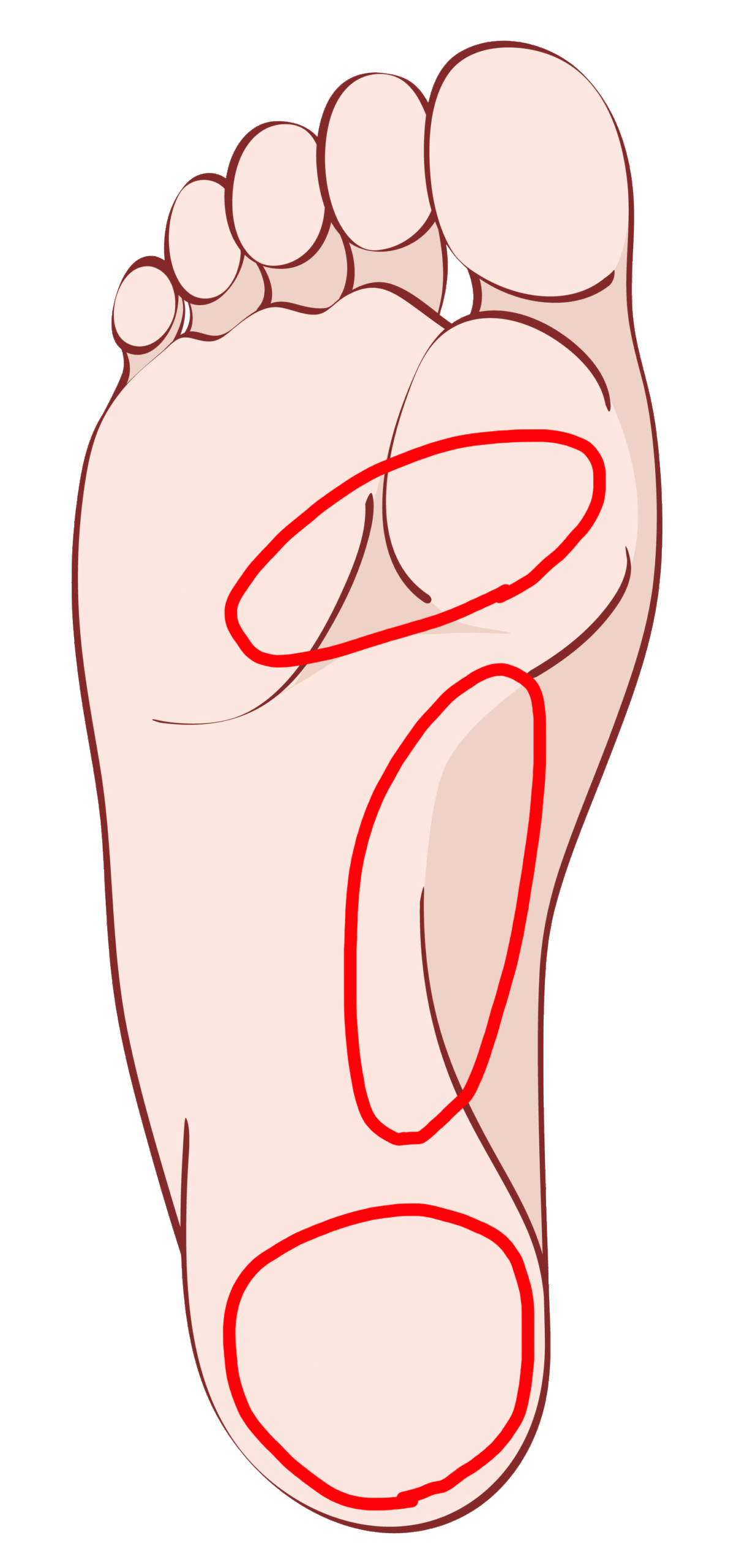 足底筋膜炎の痛みが生じる個所。 かかと部分が最も頻出する箇所となっている。